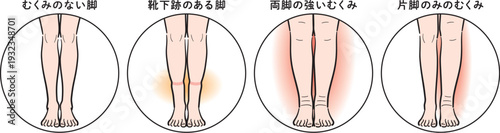 脚のむくみの症状比較（靴下跡・両脚むくみ・片脚のみ）