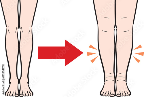 むくみのない脚からむくみのある脚への変化