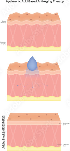 Hyaluronic Acid Based Anti-Aging Therapy for Skin Rejuvenation