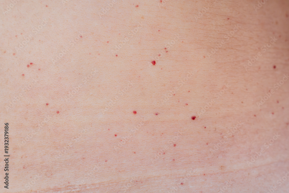 Fototapeta premium Multiple red dots or moles on the body or senile angiomas