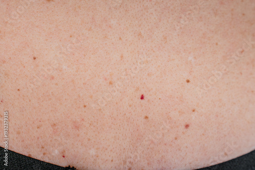 Photos Multiple red dots or moles on the body or senile angiomas