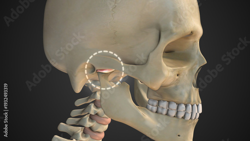 Temporomandibular Joint Disorder Causing Severe Jaw Pain