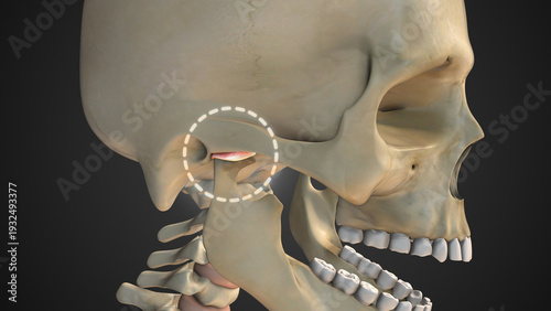 Temporomandibular Joint Disorder Causing Severe Jaw Pain