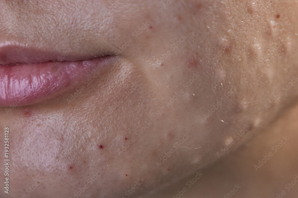 Fototapeta premium Injectable cosmetology. Facial biorevitalization procedure using a hyaluronic acid-based product. Papules on female face after biorevitalization. close-up