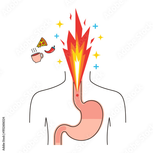 Stylized Flat Vector Illustration of GERD Acid Reflux Heartburn