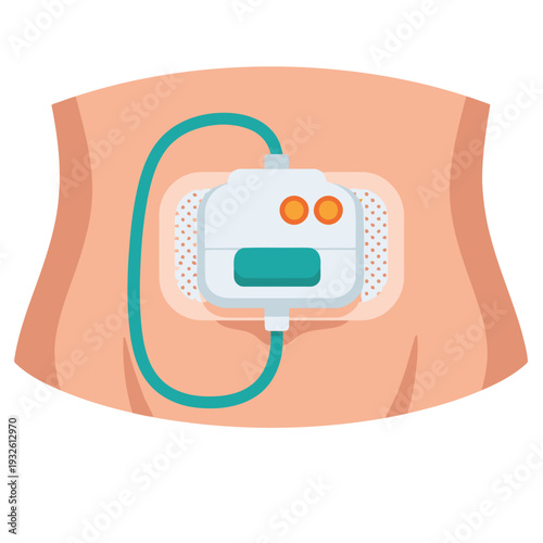 Illustration depicts an insulin pump patch on a person's abdomen, highlighting diabetes management. Clean, modern design with clear labeling. Suitable for health and wellness visuals.
