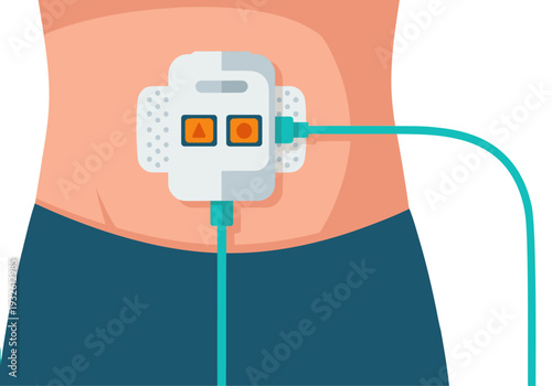 Illustration depicts an insulin pump patch on a person's abdomen, showcasing modern diabetes management. Clean, flat design with vibrant colors. Ideal for health and wellness visuals.