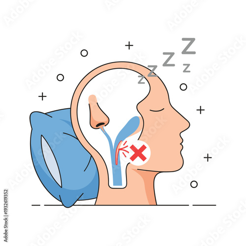 Flat Vector Diagram of Sleep Apnea Airway Blockage