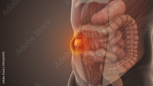 Photos Epigastric Hernia Bulge in Abdominal Wall