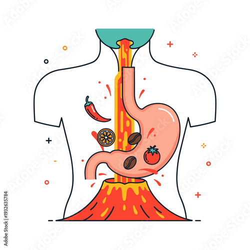 Stylized GERD Heartburn Volcano with Trigger Foods Illustration
