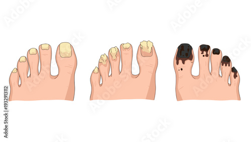 Medical illustration showing three stages of toenail fungus and nail infection on a human foot for diagnosis and treatment education.