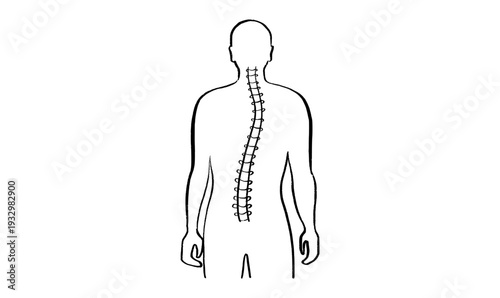 Scoliosis spine deformity