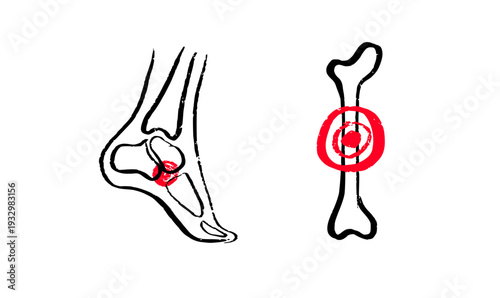 Osteomyelitis disease sketch