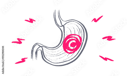 Gastroesophageal reflux pain