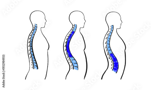 Scoliosis spine deformity