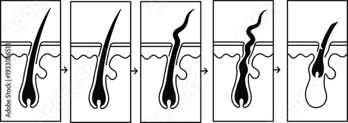 Hair follicle ingrown hair development sequence illustration showing skin anatomy stages and hair growth process in medical educational line art style