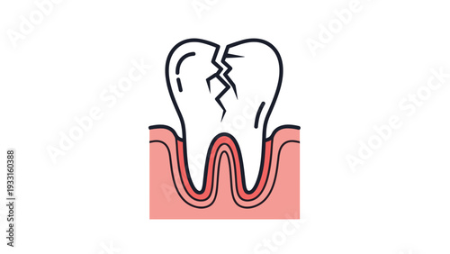 Anatomical illustration of a cracked molar tooth with visible fractures on the enamel and roots embedded in healthy gums.
