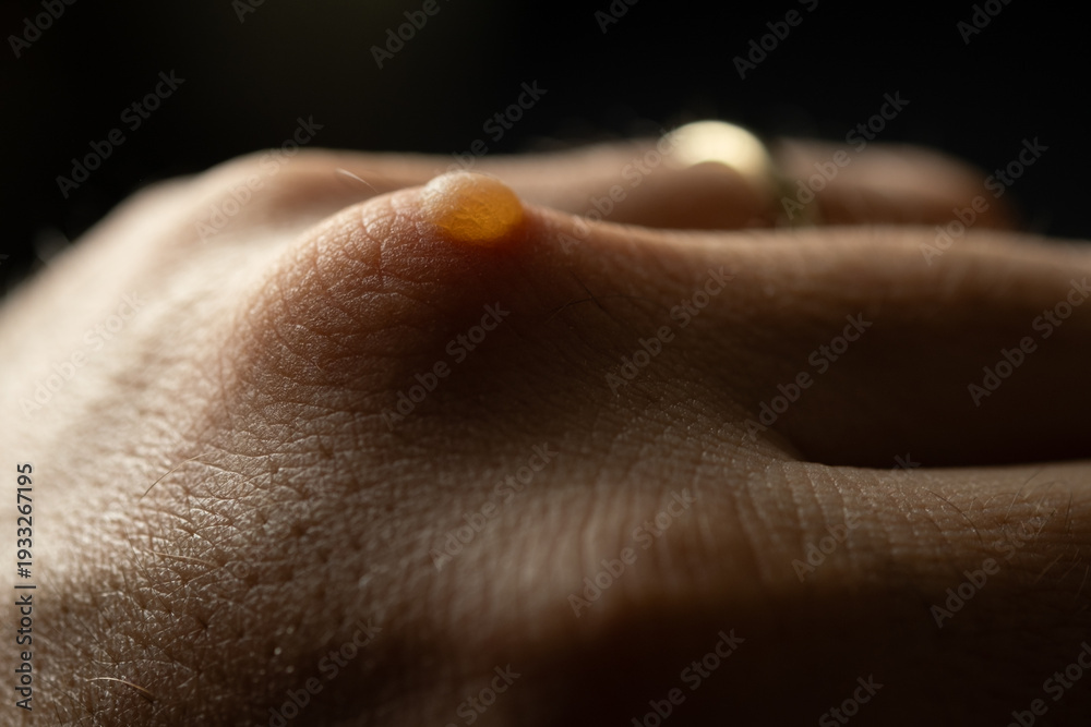 Fototapeta premium Close Up of Burn Blister on Male Hand Knuckle Black Background