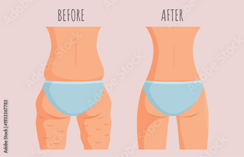 Girl with and without cellulite. Fat slim female butt, legs and back. Body before and after fitness training, diet, healthy nutrition results, sapid vector concept