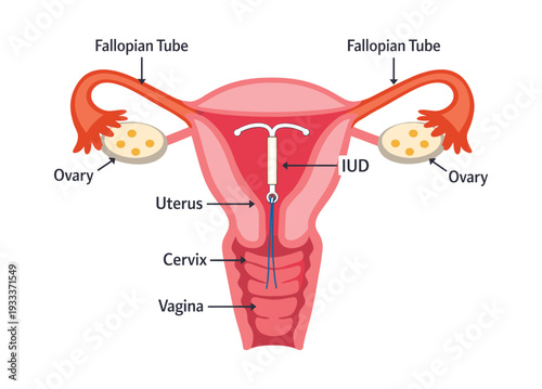 Female anatomy with intrauterine device placement, highlighting IUD birth control and contraception for women's health