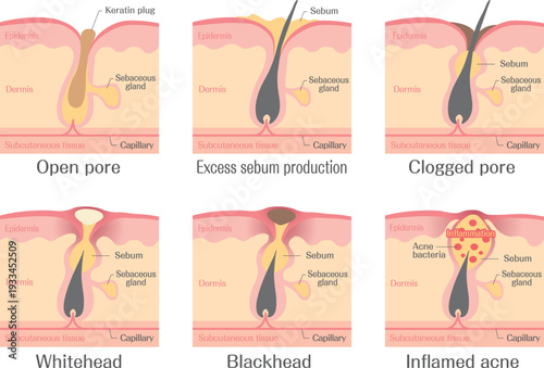 Acne formation stages and clogged pore diagram