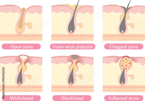 Acne formation stages and clogged pore diagram