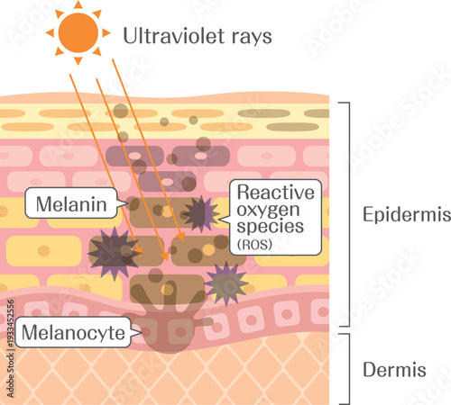 Ultraviolet rays and melanin production in skin cross section, melanocyte and reactive oxygen species diagram