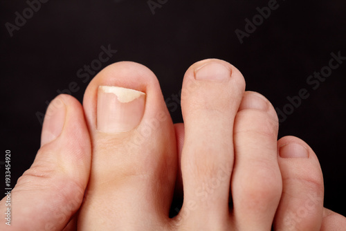 Closeup macro view of toe skin and nails. Nail detachment, fungal nail infection, onycholysis. Dermatologist or therapeutic pedicure examination, careful inspection of toenail condition, skin health