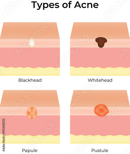 Type of Acne Diagram Vector Illustration