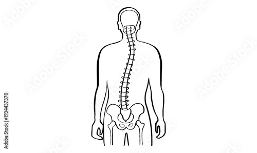 Scoliosis spine deformity