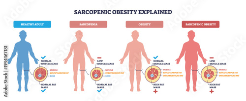 Sarcopenic obesity explained visually, four silhouettes compare muscle loss and fat gain, main objects are body silhouettes, fat-muscle cross-sections, and labels. Outline diagram