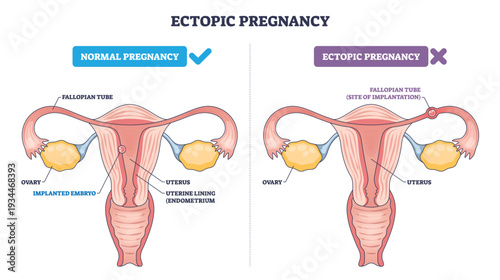 Ectopic pregnancy diagram contrasts normal uterine implantation with a tubal pregnancy, key anatomy, fallopian tube, uterus, embryo placement. Outline diagram