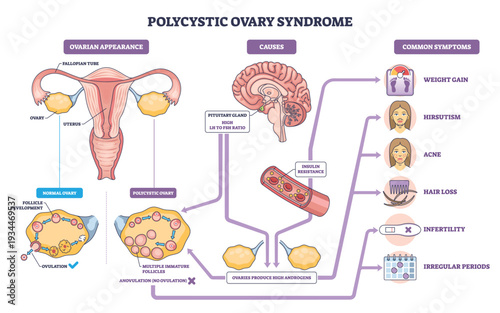 Polycystic ovary syndrome brief diagram maps causes, symptoms, and ovarian changes behind cycle issues, key objects, uterus, ovaries, symptom icons. Outline diagram