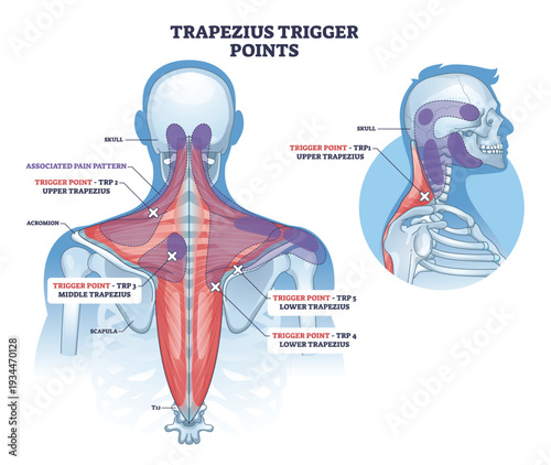 Trapezius trigger points diagram illustrates pain referral zones across neck, shoulders, and upper back, marking upper, middle, and lower fibers with X targets. Outline diagram