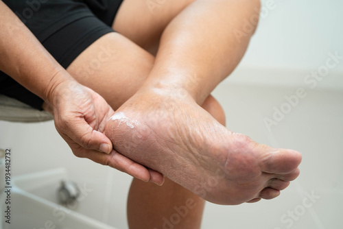 Asian woman check feet with crack and dry heel skin, Diabetic Foot.