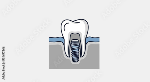 Dental Implant Illustration Demonstrating Tooth Replacement, Ideal For Healthcare Marketing