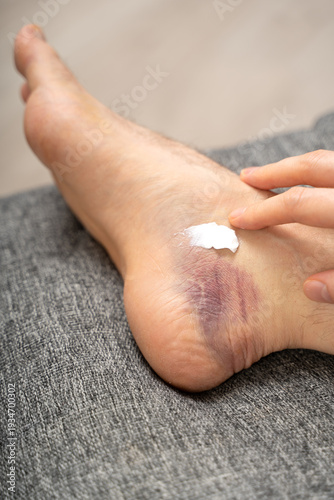 Foto Vertical close-up of man's foot with purple bruise and visible swelling, while hand gently applies white topical cream