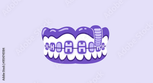 Illustrated Dental Braces in Purple Coloration and Orthodontic Treatment Process