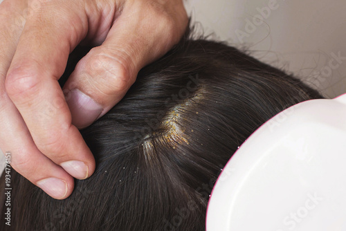 Cuadro en lienzo Close up of human scalp with visible seborrheic dermatitis symptoms, yellow dand