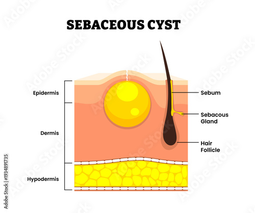 Sebaceous cyst trichilemmal cyst structure. Lump form skin hair follicle. Sebum, epidermis, dermis, hypodermis. Skin layers structure. Dermatology concept science illustration vector.