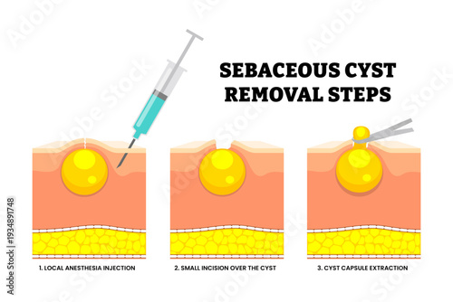 Sebaceous cyst removal steps process. Local anesthesia injection, small incision over the cyst, cyst capsule extraction. Minimally invasive excision. trichilemmal cyst excision. Skin structure.