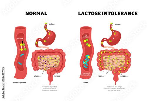 Lactose intolerance vs normal intestine. Human intestine cross section with lactase, glucose, galactose. Bacterial fermentation. Absorbed in small intestine. Gut bacteria. Vector illustration.