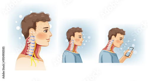 Illustration comparing neutral head posture and forward head posture from smartphone use affecting cervical spine alignment.