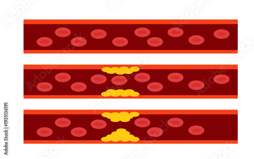 healthy and diseased vessels on a white background,