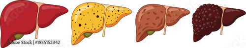 Liver Health Icon Set Featuring Different Stages and Conditions of Liver for Medical, Health, and Wellness