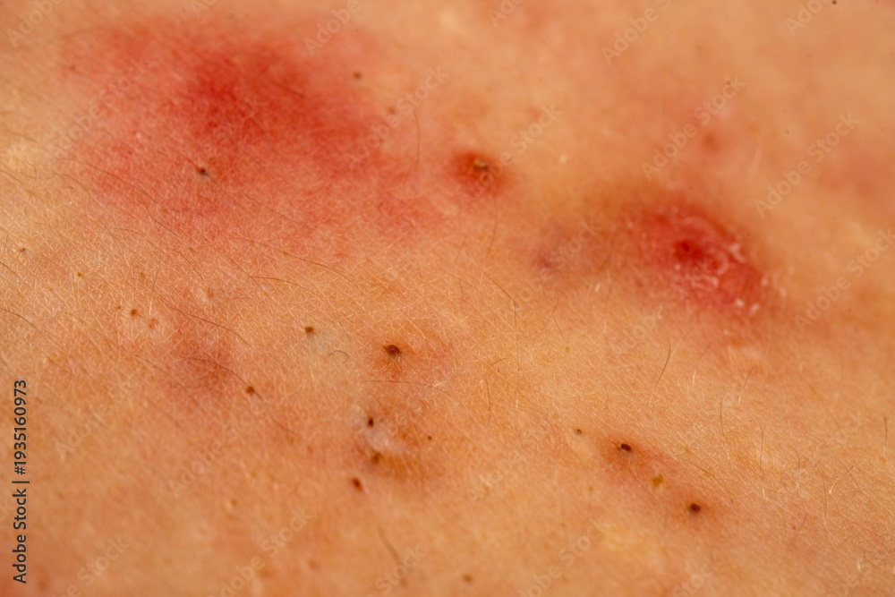 Fototapeta premium Acne close up skin problem with pimple and pores texture detail. Close up pimple in acne shows sebum, comedone, and whitehead. Acne close up with rash, papules, and blemish on skin.