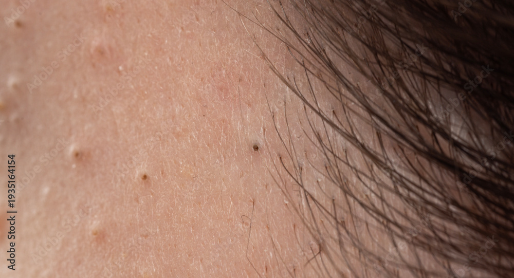 Naklejka premium Acne on skin with papules and follicles. Pimple with whiteheads and irritated pores. Dermatology skincare for acne and epidermis. Detail of pimple with sebum and blemish.
