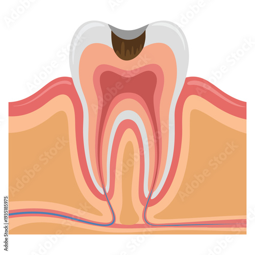 Deep caries tooth problem detailed vector illustration suitable for dentistry health education clinic presentation and oral care themes