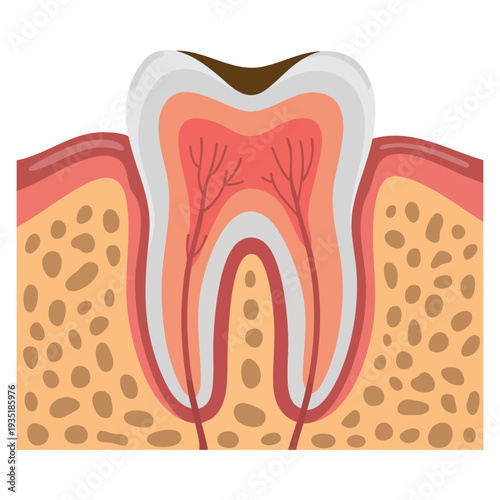 Deep caries tooth problem vector illustration isolated dental health design element perfect for dentistry education clinic and oral care themes