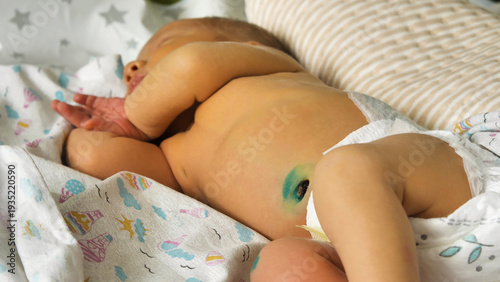 A close-up view of a newborn baby sleeping peacefully on soft, patterned bedding. The focus is on the healing umbilical cord treated with green antiseptic, symbolizing infant care and hygiene